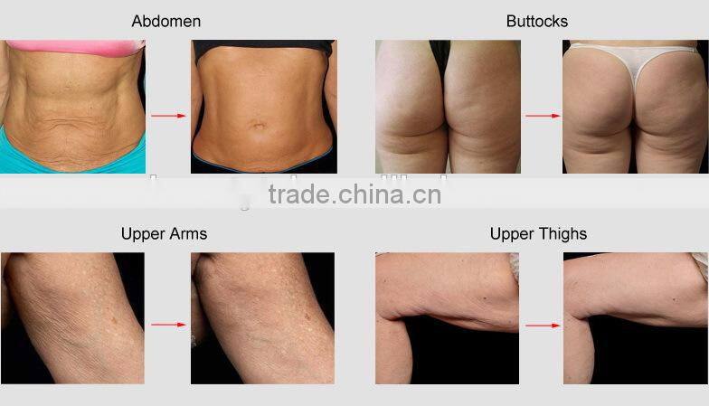 RU+5 vacuum rf ultra cavitation lipomax sound system