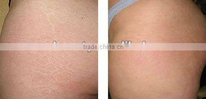 L007 Incredible device 540 Derma Roller Medical Dermaroller