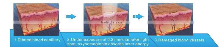 Hot Selling Proffessional 980nm Diode Laser JM980 Details CE Approved