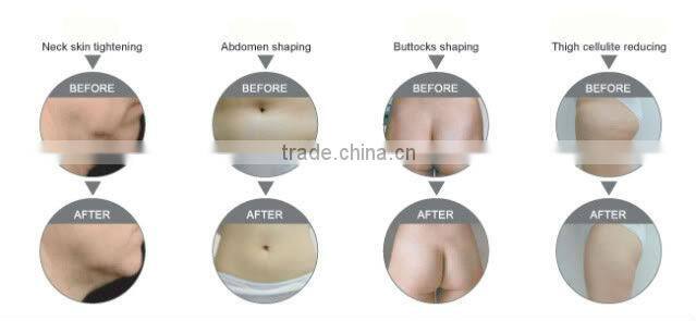 Manufacturer supply 4 handles quick slimming fda approved ultrasonic cavitation liposuction beauty equipment