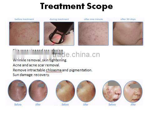GGLT RF tube CO2 fractional laser vaginal tightening Skin rejuvenation machine price