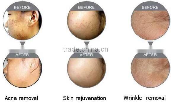 Acne Blue Red LED Light Therapy 48 LED Bulbs for Treatment Acne and Acne Scars 415nm 660nm