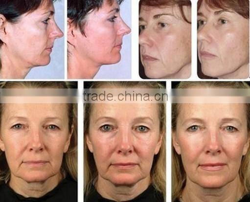 face treatment fractional microneedle beauty machine rf lifting price