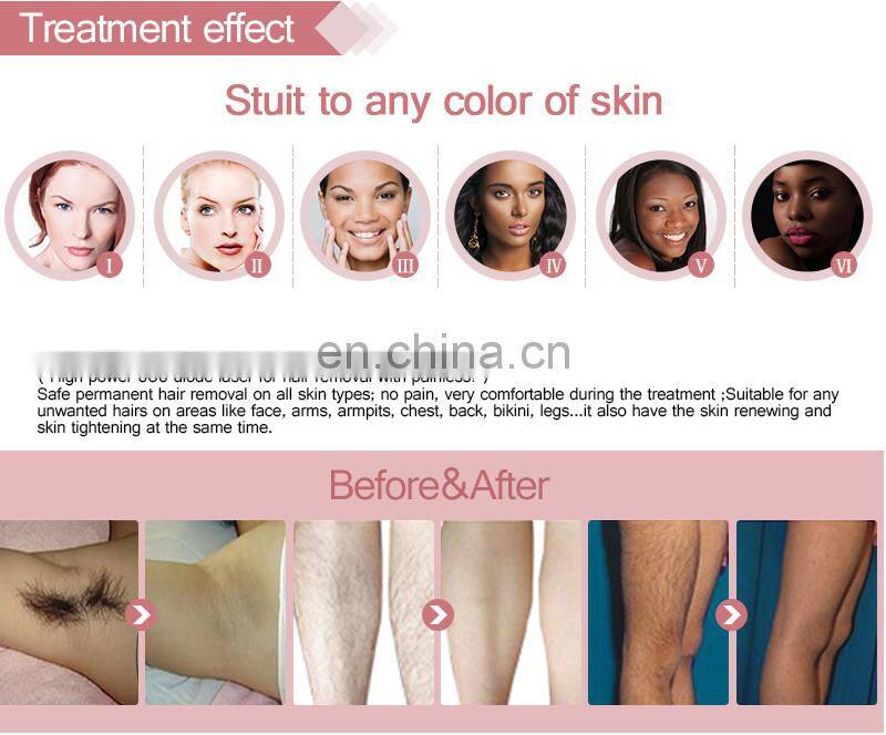 Alma Soprano ICE 808 hair removal machine Israel Germany laser