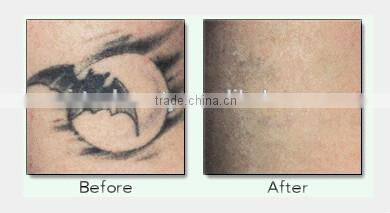 Vertical Multifunctional SHR hair removal machine