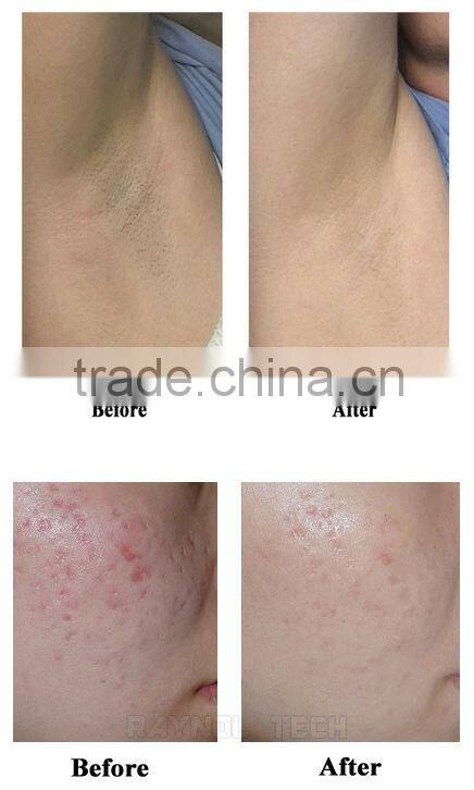 RoHs Approval Touch Screen SHR IPL Laser Permanent Hair Removal Machine