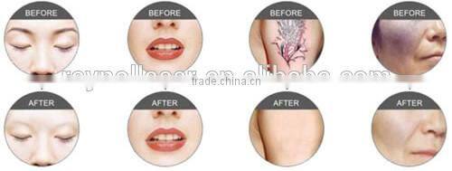 Portable 6Hz Q Switched Nd:YAG Laser Tattoo Removal Machine