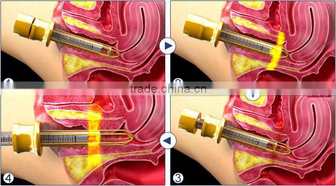 vaginal tightening machine Good price woman Painless Vaginal Tightening Machine/vaginal hifu