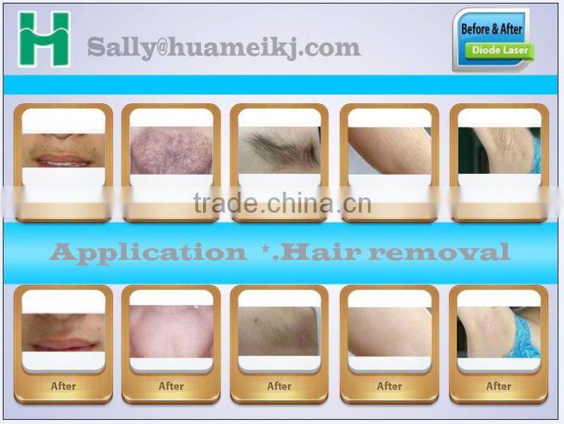 Hot selling hair removal 808nm diode laser machine / diode laser hair removal