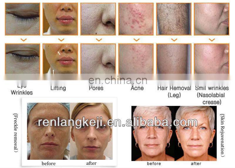 Personal IPL Hair Removal Machine for Home Use