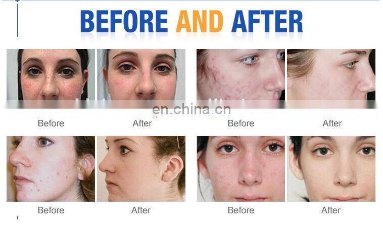 Factory wholesale water oxygen jet peel diamond dermabrasion machine