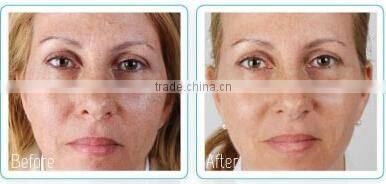 Fractional rf micro needle / microneedle rf machine