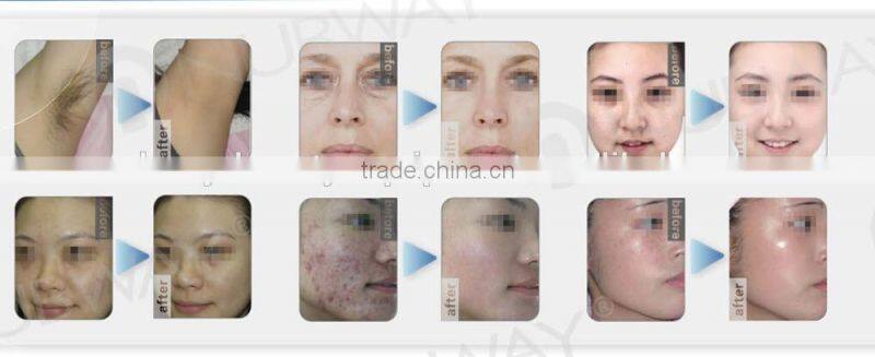 New high energy best professional new style shr /opt/aft ipl elight rf laser hair removal machine