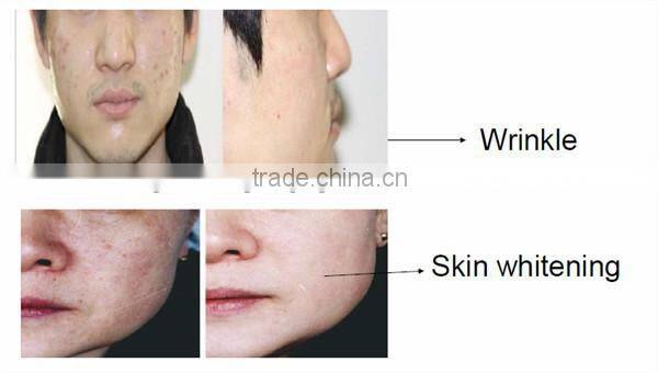 2015 hot selling radiofrecuencia rf portable equipment