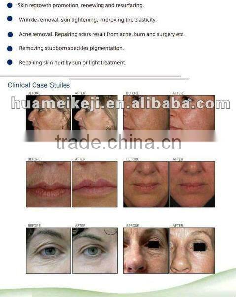 2013 Newest!!! 808/810nm Diode Laser for fast hair removal -NEO