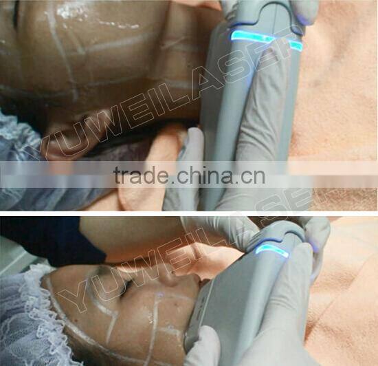Factory price hottest an-wrinkle high intensity focused ultrasound machine