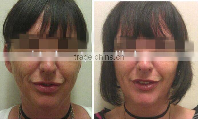 Skin Care System/LED/PDT Skin Rejuvenation Machine