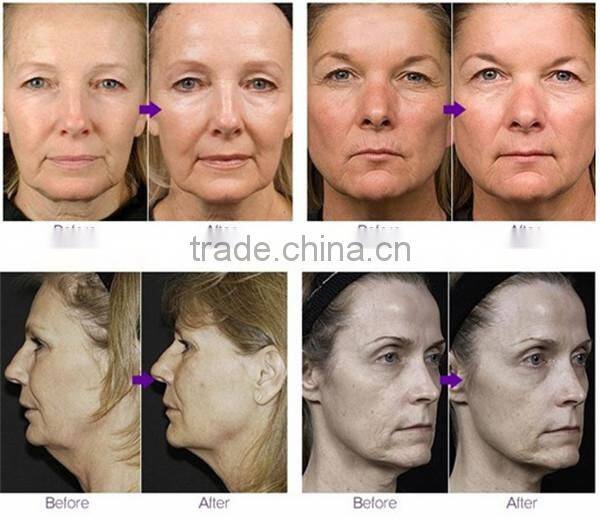 RF fractional microneedle radiofrequency