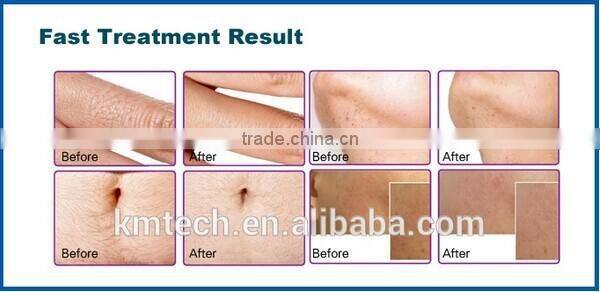 2016 hot sale diode laser 808nm diode laser device hair removal machine two kinds can choose