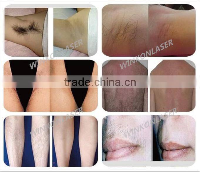 beauty equipment/hair salon equipment/diode laser hair removal