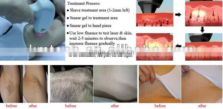 super power supply portable diode laser hair removal machine