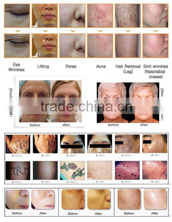 Professional E-light IPL permanent hair removal equipment rf skin rejuvenation