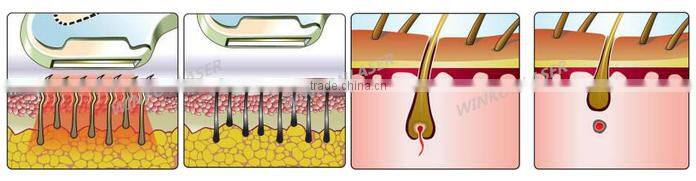 laser physical therapy equipment with e light/nd yag laser functions