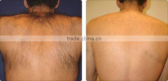 Plywood box packing 808nm Diode Laser hair removal Machine