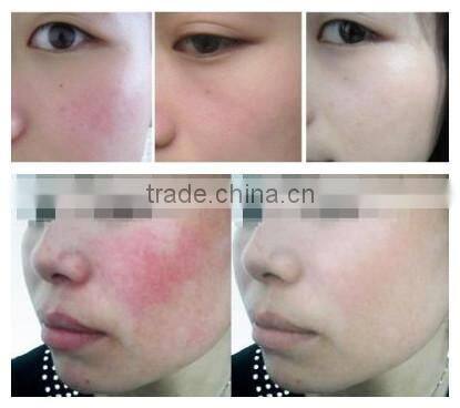 distributor price for mini 980nm laser machine for spider vein removal for sale