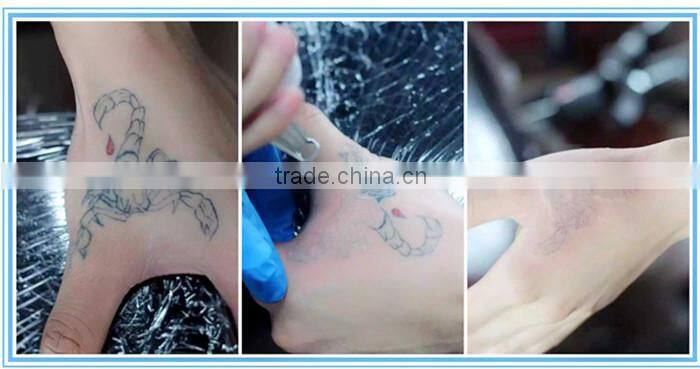 keyword:nd yag laser tattoo removal machine