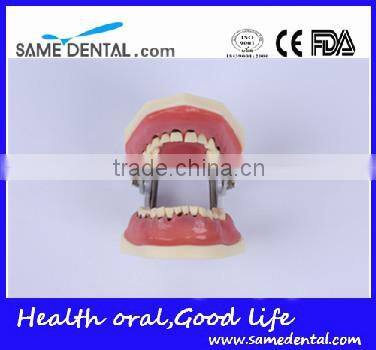 Dental Severe Periodontal Disease Model School Teaching