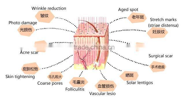2015 best co2 laser skin resurfacing fractional co2 laser equipment