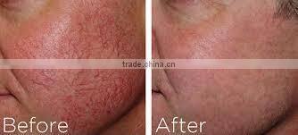 New shr ipl equipment for distributor Vertical IPL SHR&E-light hair removal equipment&machine