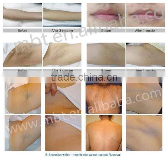 2016 MIcro channel 808nm diode laser hair removal beauty machine