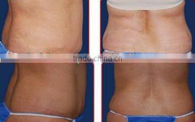 BRG80s High Quality Criolipolisis Loss Machine with 3 Cryo Handles Cryoshape