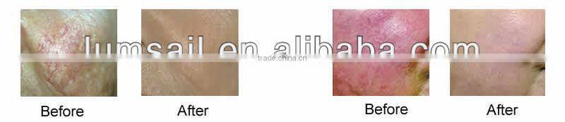 Spider Vein Removal machine Capillary Removal equipment