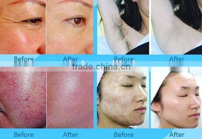 2016 online shopping 3 in 1 elight hair removal / rf / ipl hair removal machine / nd yag laser hair Removal machine