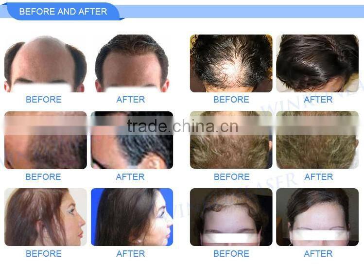 2017 alibaba hot sale laser hair growth device professional beauty machine