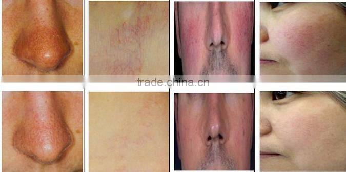 TOP 1 sale!!! Immediately results high frequency spider vein removal machine removal of skin tags