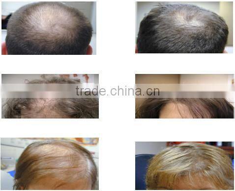 Professional Laser Hair Regrowth Machine/Diode Laser Hair Regrowth Machine