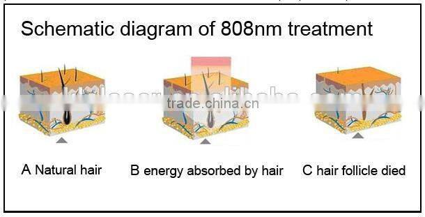 KLSi Painless depilation Diode Laser(808nm)