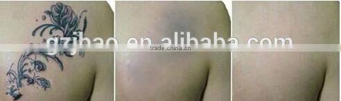 tattoo removal laser beauty equipment eyeline removal machine