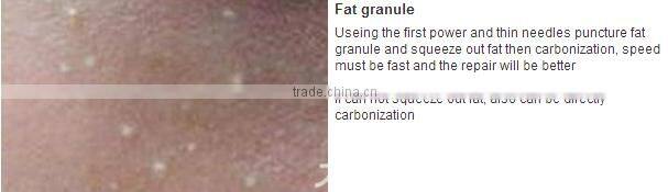 Plasma pen removal tattoo skin pen treatment tattoo removal pen