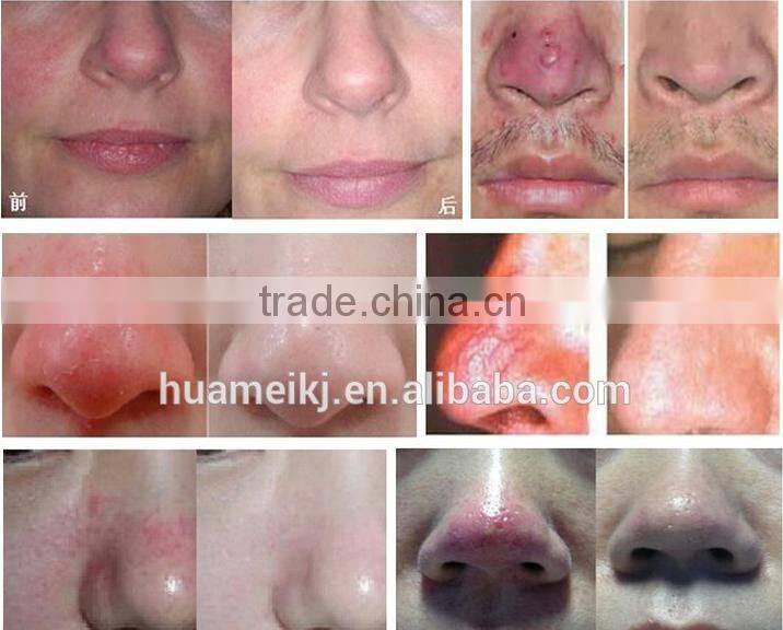 Best selling products 980nm diode laser spider veins removal machine/EVLT laser machine