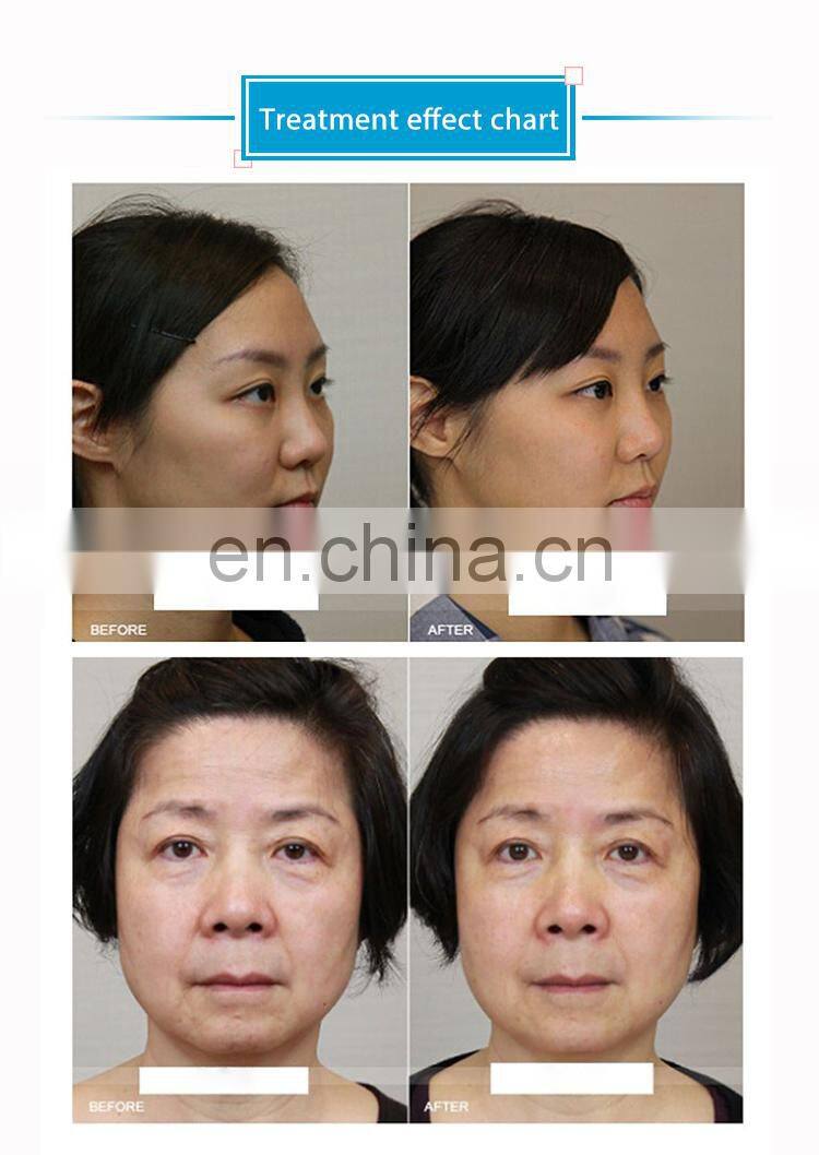 Skin Therapy facial lifting wrinkle removal radar line engraving+hifu device for anti-aging