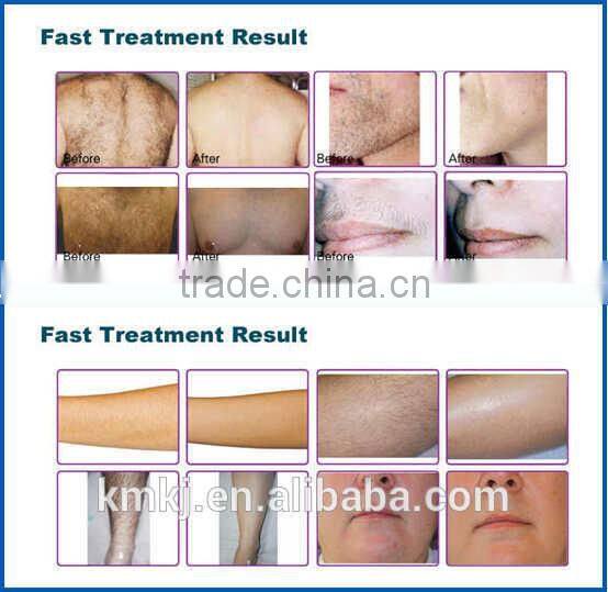2016 Newest 808nm diode laser / 808 diode laser hair removal machine portable