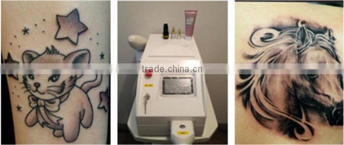 Beijing Sanhe manufacturer portable q switched nd yag laser tattoo removal and skin rejuvenation/ system skin rejuvenation