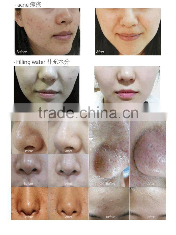 2017 Hot sale mini water peeling dermabrasion/ portable water oxygen jet peel machine