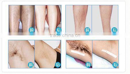 Y8 Painless 808nm diode laser hair removal machine for sale