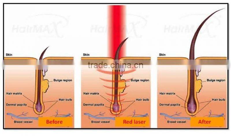 PDT Led Laser Diode Hair Regrowth Machine For Hair Lossing